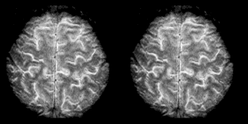 Dwie wizualizacje mózgu z kolorowymi obszarami sygnału fMRI podczas ruchów palców.